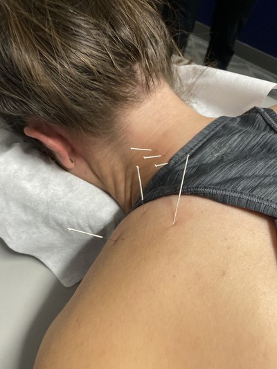 Dry Needling